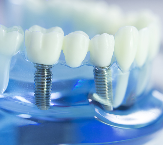 City of Industry Dental Implants